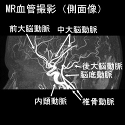 MR血管撮影側面