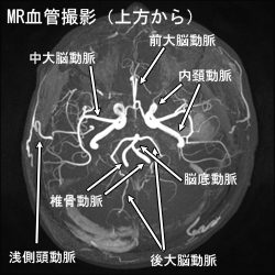 MR血管撮影（上方から）
