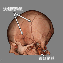 3D-CTA頭蓋外側面